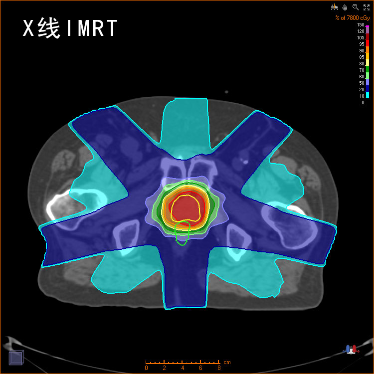 X線IMRT