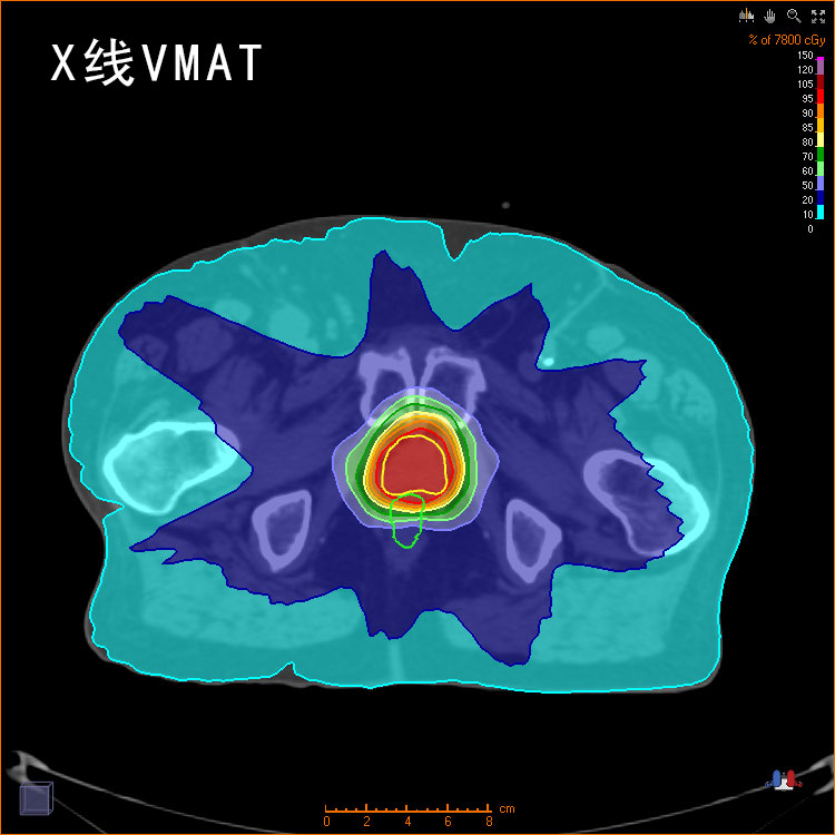 X線VMAT