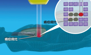 重粒子线治疗的优点