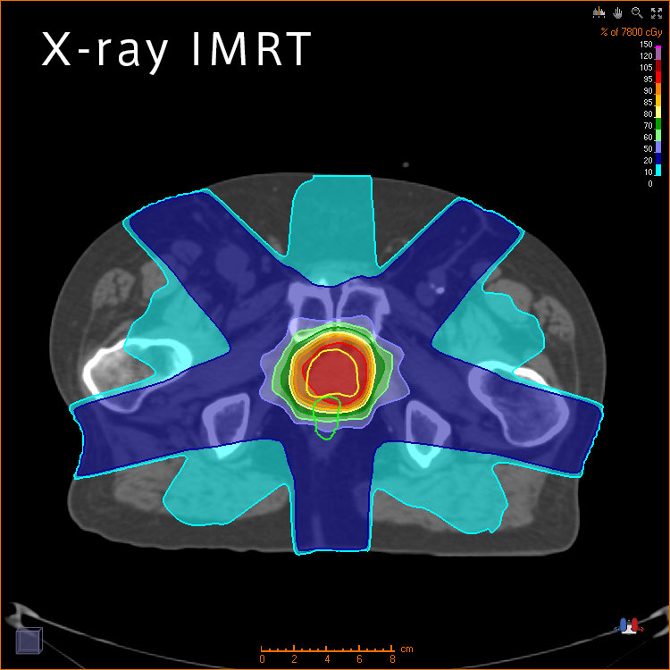 X-ray IMRT
