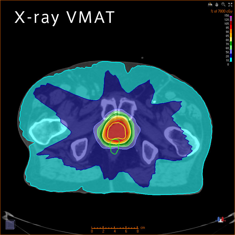 X-ray VMAT