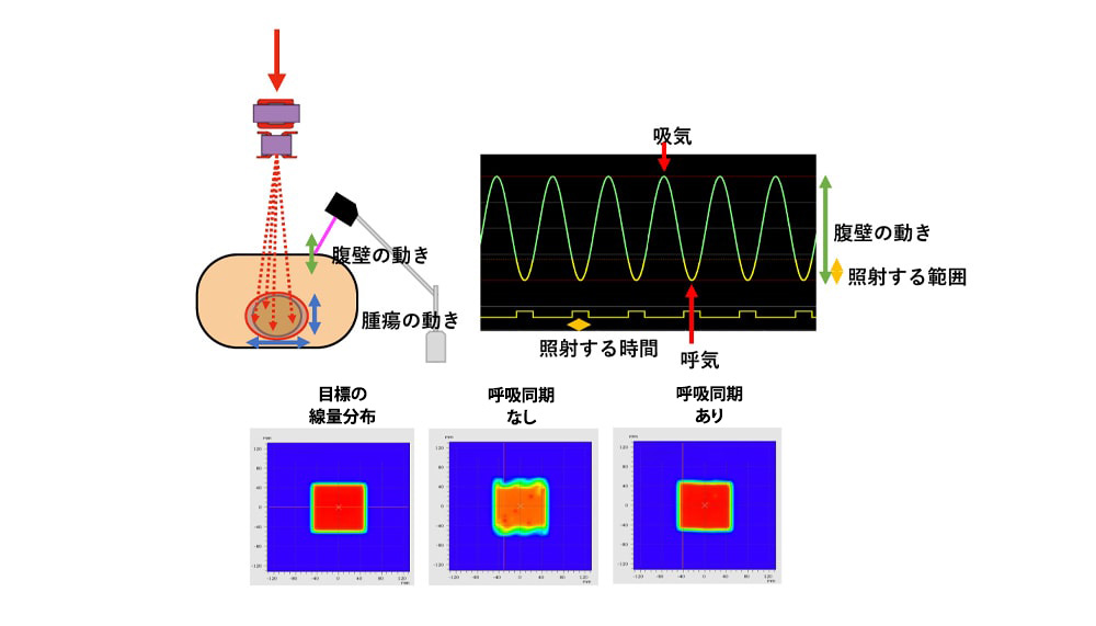 呼吸同期照射システム