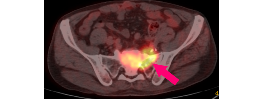 再手術非適応の大腸癌術後骨盤内再発画像イメージ